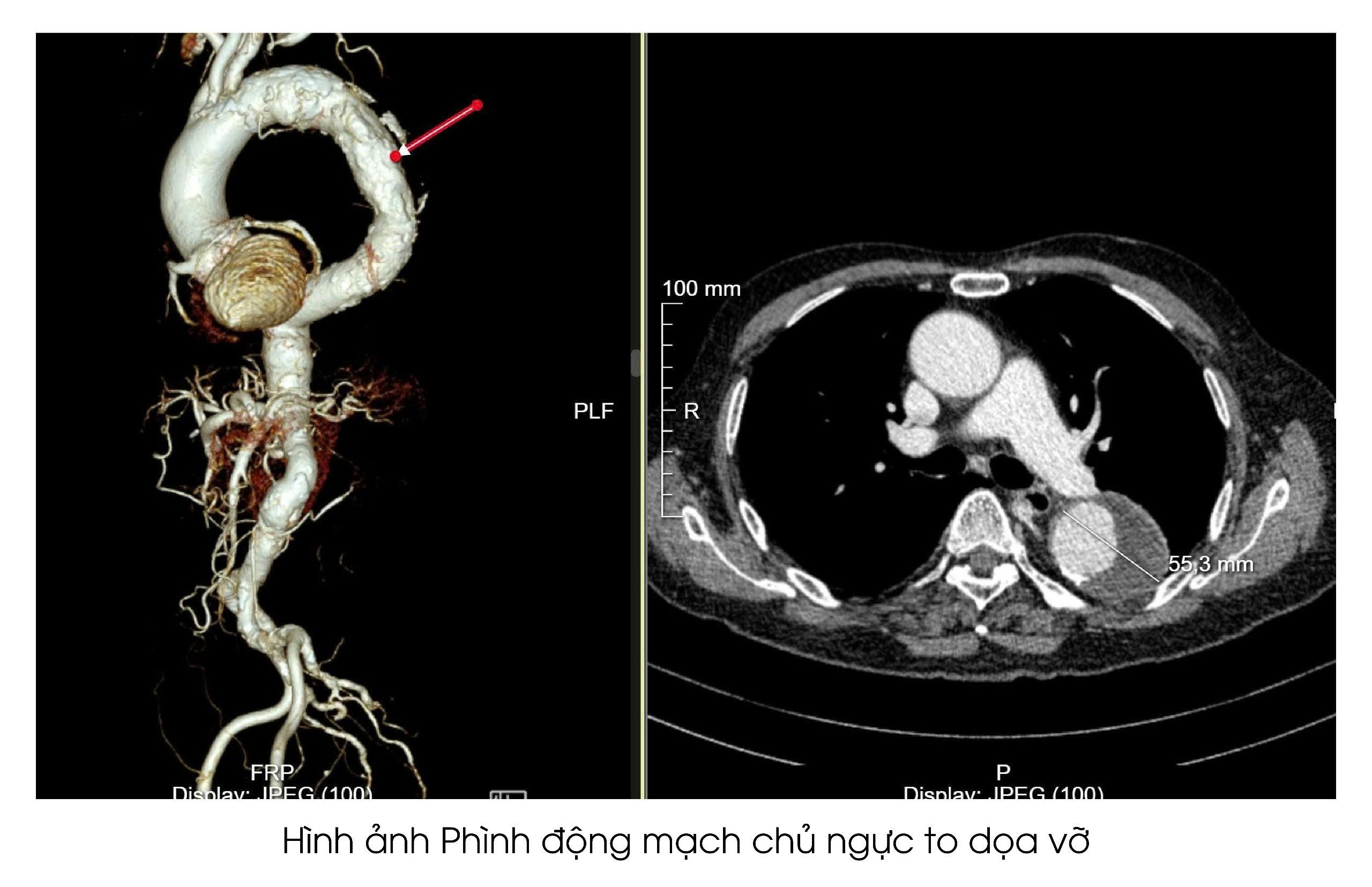 nguy-co-vo-dong-mach-chu-1780450837.jpg