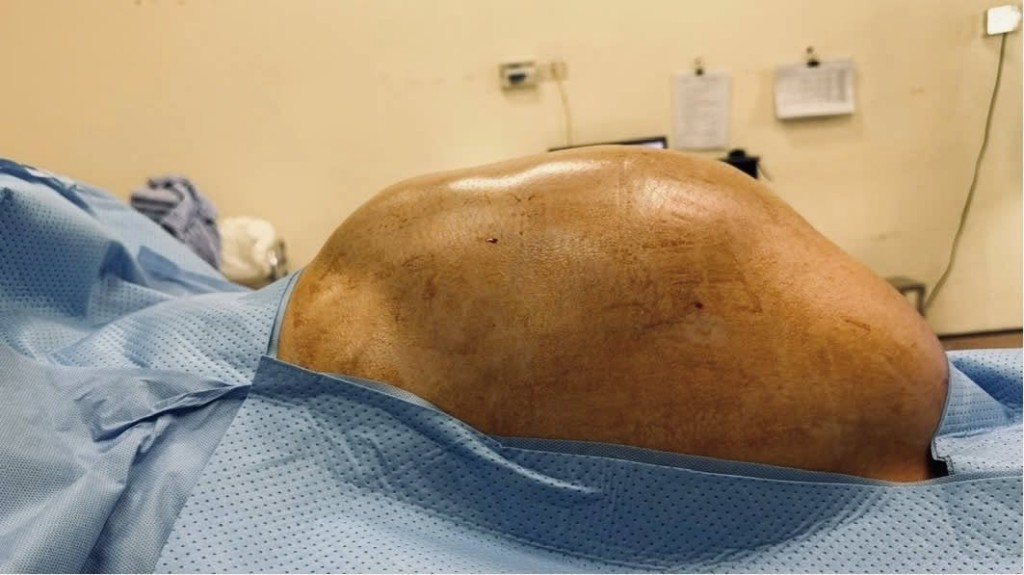 bung-co-gai-hmong-khoi-u-buong-trung-15kg-truoc-mo-1781248617.jpg