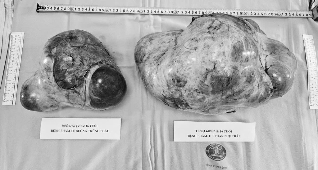 hai-khoi-u-buong-trung-15kg-benh-vien-k-1781248617.jpg