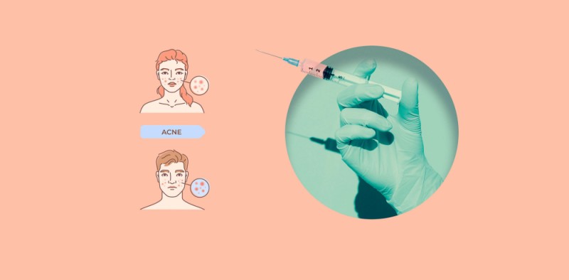 Vaccine trị mụn đầu tiên của thế giới đi vào thử nghiệm lâm sàng