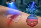 Công nghệ nano kích hoạt bằng ánh sáng mở ra hướng mới trong điều trị vết thương mãn tính
