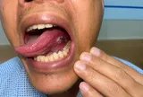 Ung thư lưỡi có thể điều trị hiệu quả nếu được phát hiện sớm
