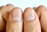 Dấu hiệu trên móng tay có thể báo hiệu bệnh lý tiềm ẩn