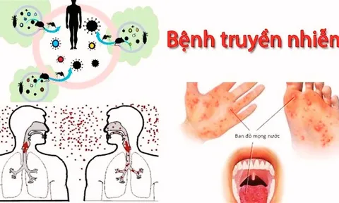 Bộ Y tế ban hành danh mục mới về bệnh truyền nhiễm