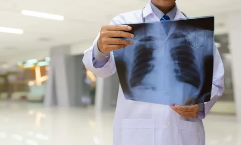 Ho kéo dài, khạc đờm mỗi sáng có thể là dấu hiệu sớm của bệnh phổi tắc nghẽn mạn tính