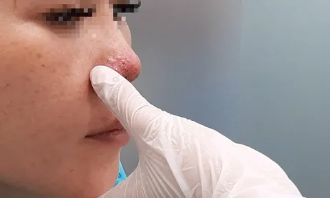Tiêm filler nâng mũi ở spa, một phụ nữ ở TP.HCM bị biến chứng hoại tử