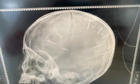 Bé 3 tuổi bị cắm đinh vào đầu: Nghi phạm là nhân tình của mẹ