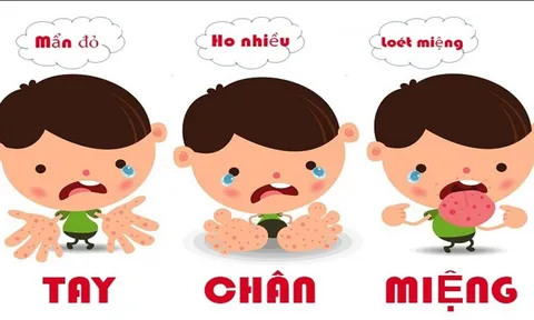 Bộ Y tế cảnh báo xu hướng gia tăng ca tay chân miệng