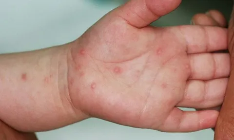 Trẻ bị tay chân miệng cần ăn uống ra sao để tăng sức đề kháng?