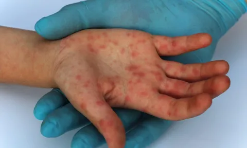 Thêm 1 loại vaccine ngừa bệnh đậu mùa khỉ được châu Âu phê duyệt