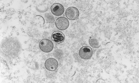 Chủng virus đậu mùa khỉ gây bệnh ở Ấn Độ và châu Âu không giống nhau