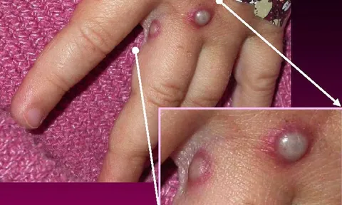 Cách phân biệt bóng nước của bệnh đậu mùa khỉ và bệnh zona