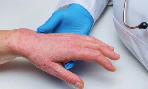Bộ Y tế yêu cầu giám sát 21 ngày người nhập cảnh từ nơi có đậu mùa khỉ