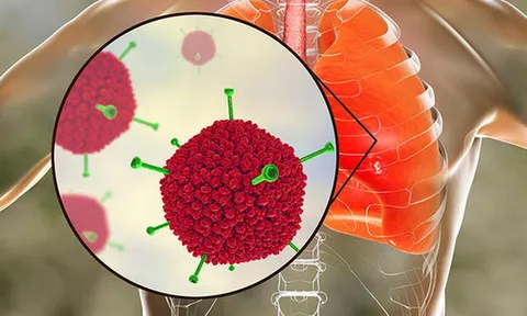 Các ca nhiễm do virus Adeno tăng đột biến, bác sĩ khuyến cáo cách phòng bệnh