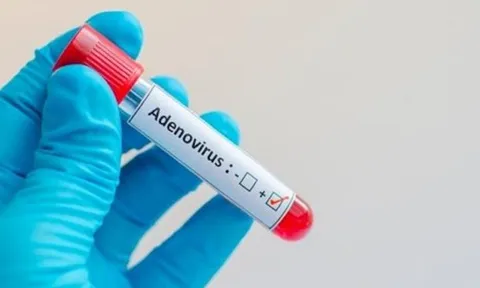 Khi nào cần xét nghiệm Adenovirus?