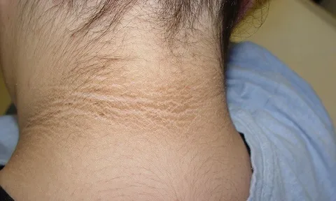 “1 đen, 2 hôi” trên cơ thể là tín hiệu tiểu đường sớm nhưng nhiều người nhắm mắt làm ngơ