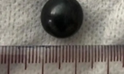 Nội soi gắp dị vật là viên bi trong mũi trẻ 3 tuổi