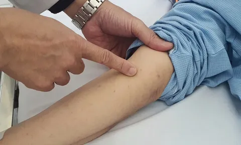 Nhiễm não mô cầu có thể tử vong trong 24h