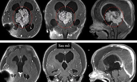 Bác sĩ cảnh báo dấu hiệu cần nhập viện ngay khi bé sơ sinh bị u não