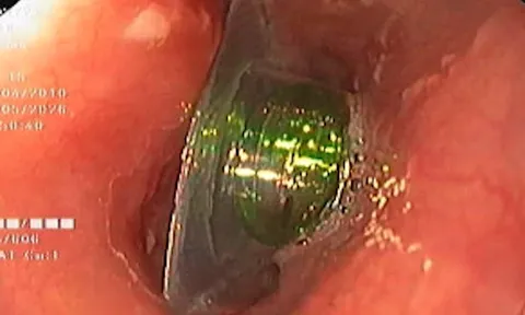 Nuốt nhầm viên thuốc còn nguyên vỏ: Cảnh báo biến chứng nguy hiểm ở trẻ em