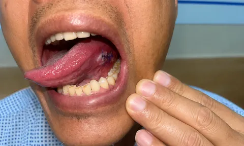 Ung thư lưỡi có thể điều trị hiệu quả nếu được phát hiện sớm