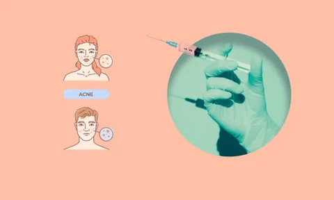 Vaccine trị mụn đầu tiên của thế giới đi vào thử nghiệm lâm sàng