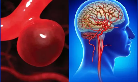 Mạch máu của người đàn ông như "ống dẫn dầu" sau bữa tối, bác sĩ tức giận: Ăn thế này có ngày tử vong