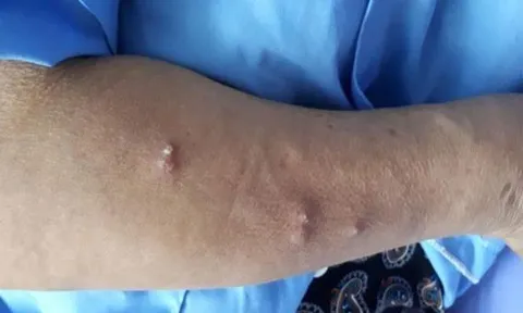 Người phụ nữ ở Sài Gòn nhiễm "vi khuẩn ăn thịt người"