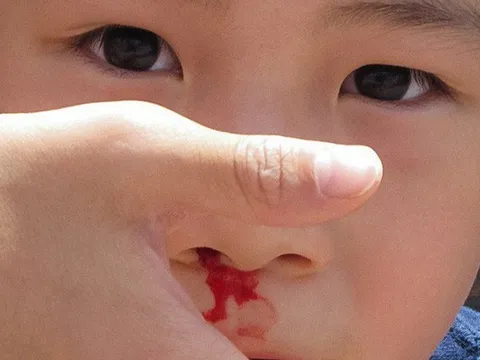 Chảy máu cam ở trẻ gia tăng khi thời tiết hanh khô và cách xử trí