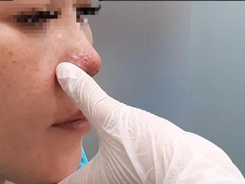 Tiêm filler nâng mũi ở spa, một phụ nữ ở TP.HCM bị biến chứng hoại tử
