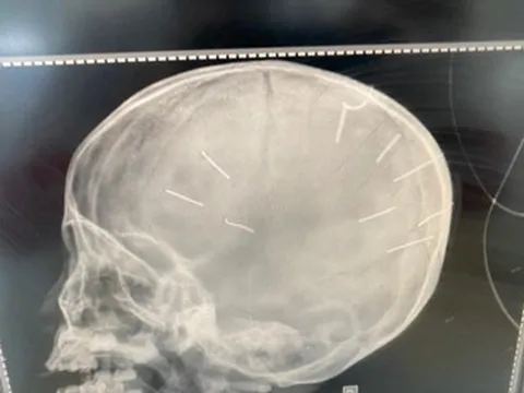 Bé 3 tuổi bị cắm đinh vào đầu: Nghi phạm là nhân tình của mẹ