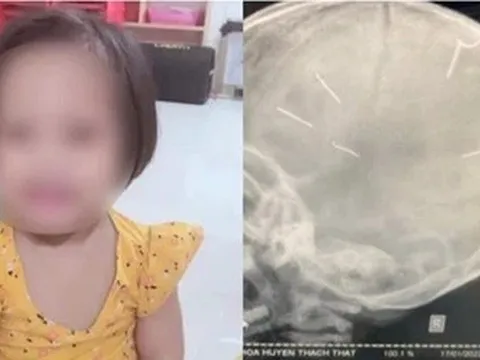 Bé gái 3 tuổi bị đóng đinh vào đầu ở Hà Nội đã tử vong