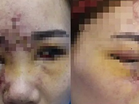 Biến chứng nặng nề khi tiêm filler 'đội lốt' collagen