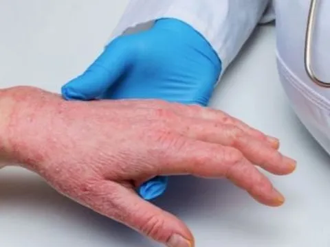 TP.HCM lên phương án giám sát bệnh đậu mùa khỉ