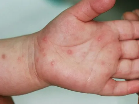 Trẻ bị tay chân miệng cần ăn uống ra sao để tăng sức đề kháng?