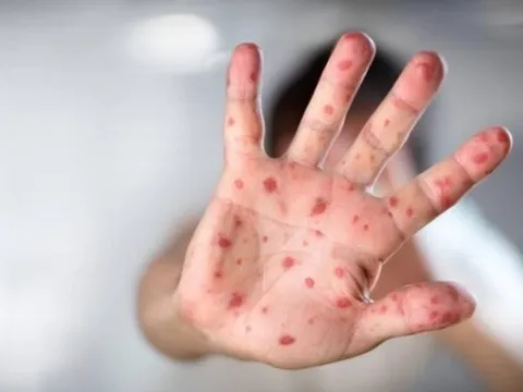 Dịch tay chân miệng tại Hà Nội đã vượt mốc 1.000 ca, khuyến cáo phụ huynh giữ vệ sinh cho con