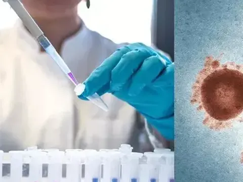 Bộ Y tế khuyến cáo 6 biện pháp phòng chống bệnh đậu mùa khỉ