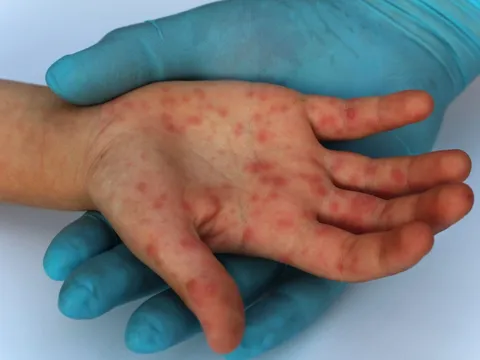 Thêm 1 loại vaccine ngừa bệnh đậu mùa khỉ được châu Âu phê duyệt