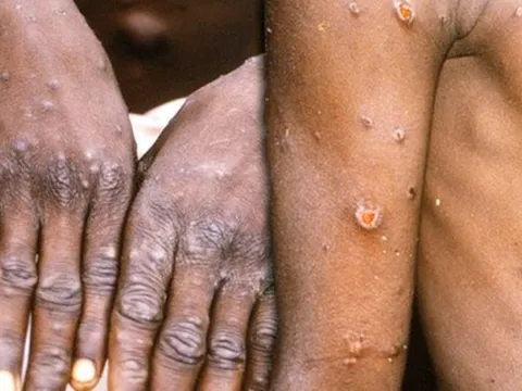 Ca tử vong đầu tiên do bệnh đậu mùa khỉ tại Tây Ban Nha