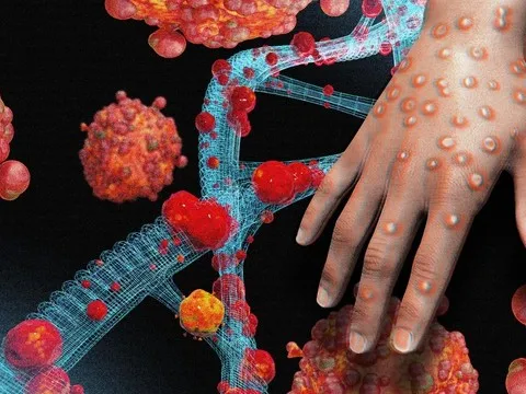 Phòng chống bệnh đậu mùa khỉ: Cần sớm hơn một bước, nhanh hơn một bước