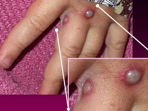 Cách phân biệt bóng nước của bệnh đậu mùa khỉ và bệnh zona