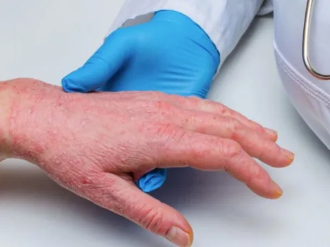 Bộ Y tế yêu cầu giám sát 21 ngày người nhập cảnh từ nơi có đậu mùa khỉ