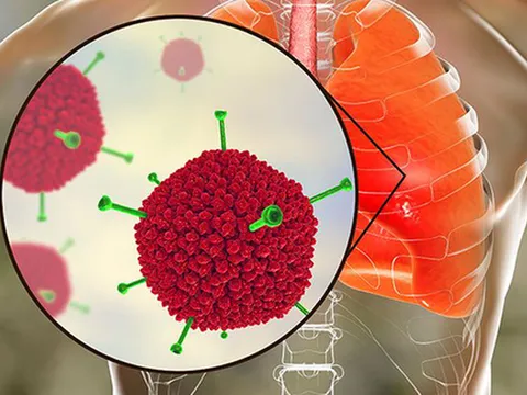 Các ca nhiễm do virus Adeno tăng đột biến, bác sĩ khuyến cáo cách phòng bệnh