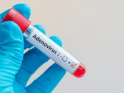 Khi nào cần xét nghiệm Adenovirus?
