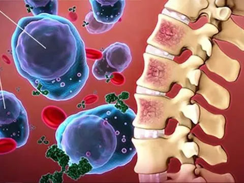 FDA phê duyệt thuốc trị đau tủy xương tái phát mới