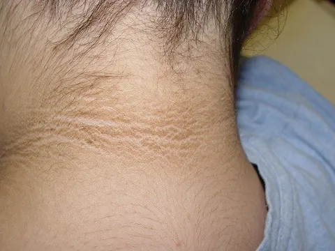 “1 đen, 2 hôi” trên cơ thể là tín hiệu tiểu đường sớm nhưng nhiều người nhắm mắt làm ngơ