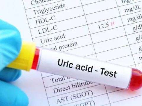 Mẹo kiểm soát nồng độ axit uric trước khi đi ngủ