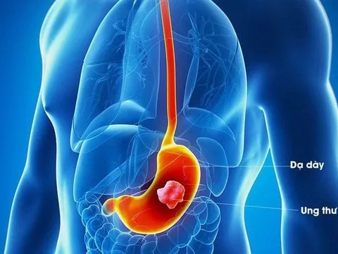 Nguyên nhân gây ung thư dạ dày là gì?