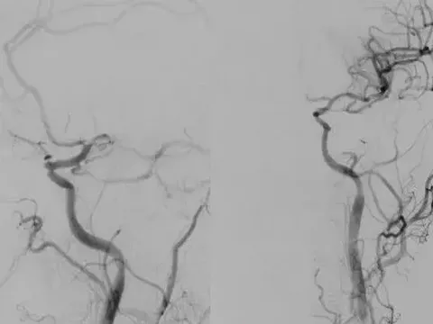 Cấp cứu người bệnh bị đột quỵ với thể trạng yếu nửa người, mất ngôn ngữ sau khi thức giấc