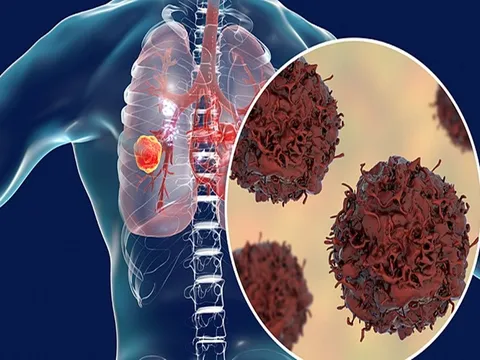 U phổi chỉ còn là sẹo sau điều trị hóa trị, thuốc miễn dịch và sản phẩm của BCC Pharma